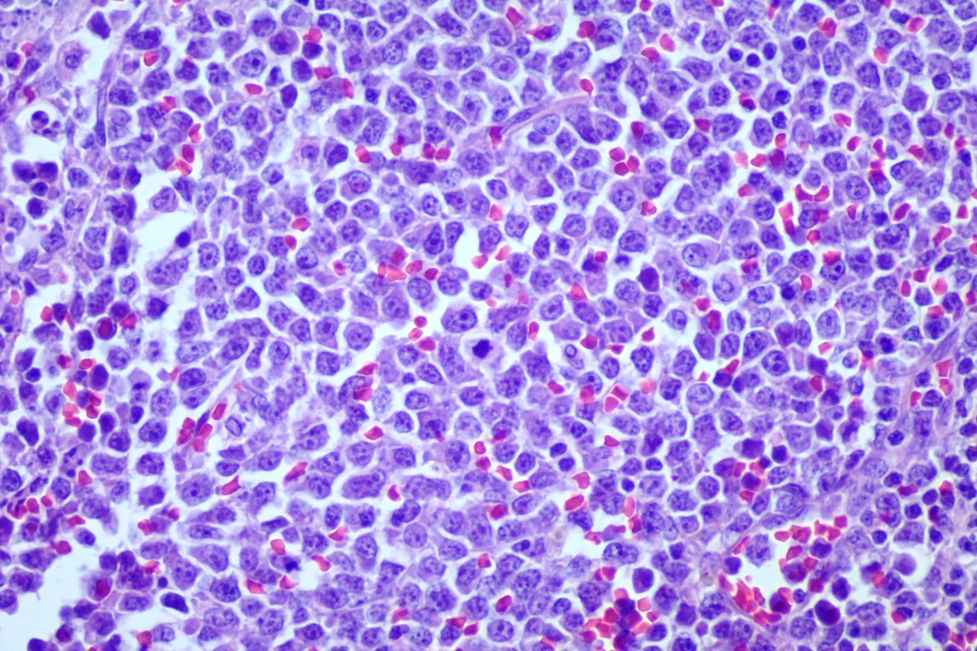 Patología Oncológica