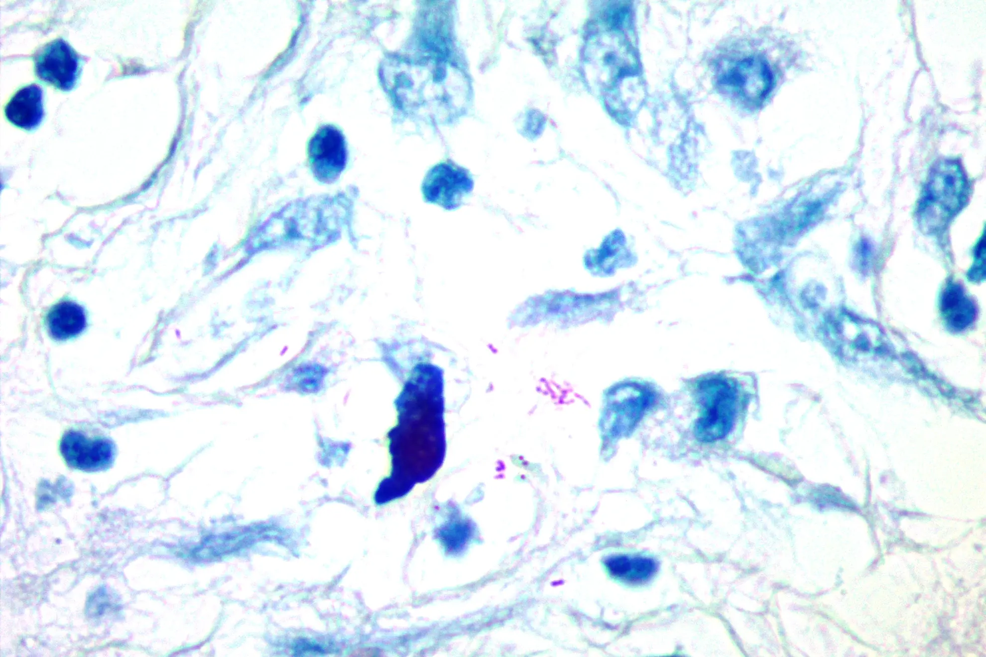 Patología Torácica
